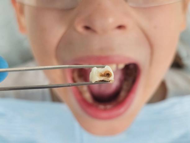 Best Emergency Root Canal Treatment in Indian River Estates, FL